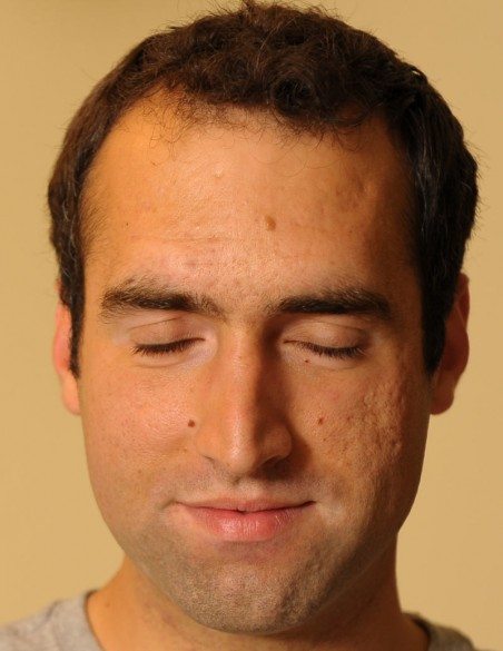 Facial Vitiligo 70