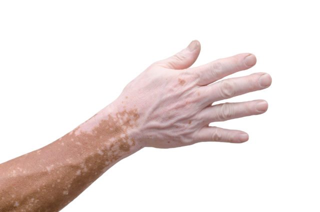 Vitiligo on the hand