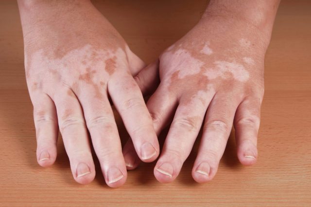 What causes vitiligo?