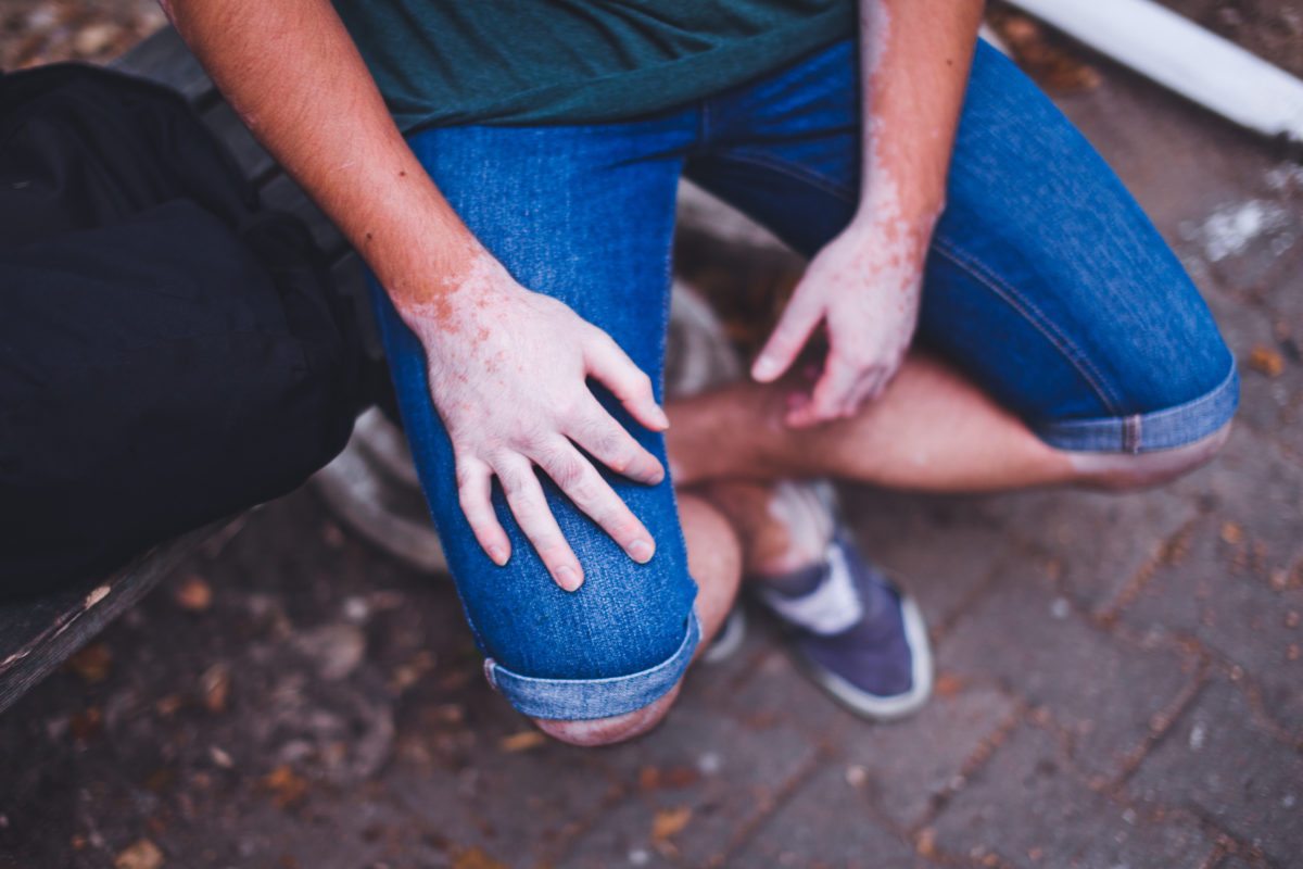 What are they symptoms of vitiligo?